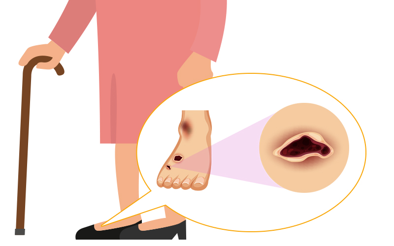 糖尿病足預防8式你要識