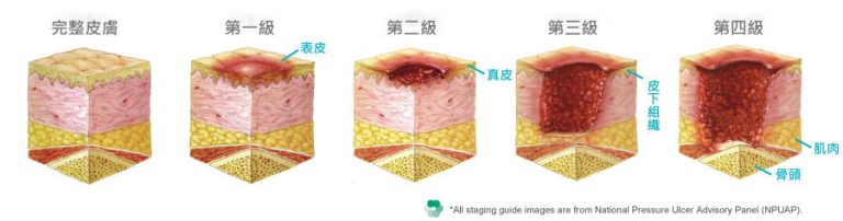 長期臥床必有壓瘡 | 「老友宅醫」網站